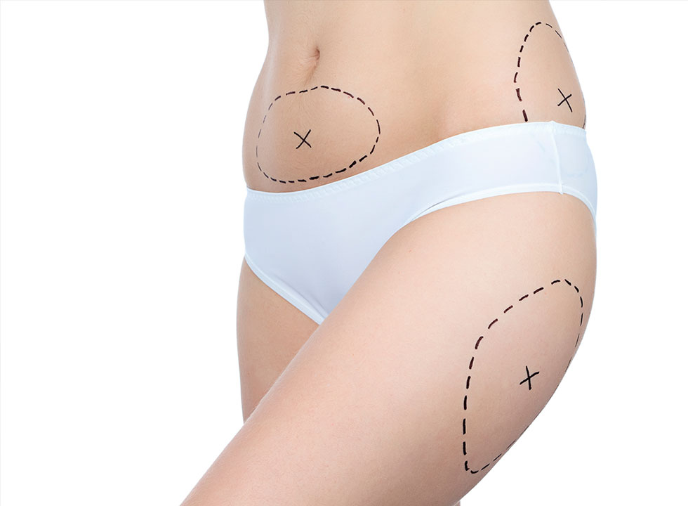 AQUALYX Zakažite Laserski SMART LIPO Tretman