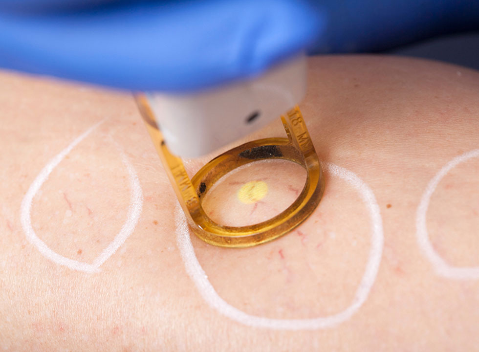 ND-Yag-laser-2 (1) Zakažite Lasersko Uklanjanje Kapilara I Hemangioma