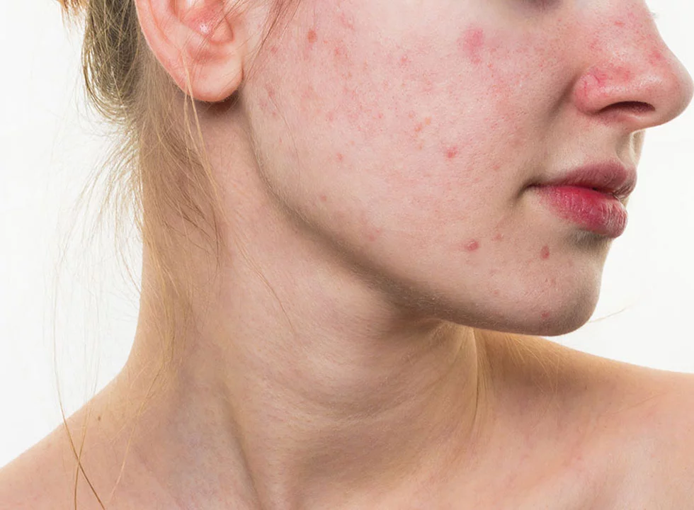 akne Zakažite PIXEL Piling